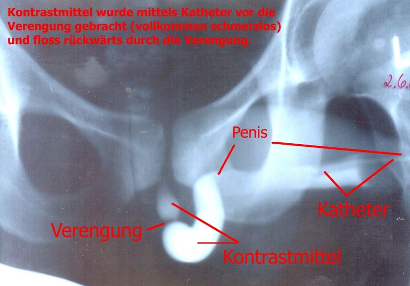 Urethral stricture