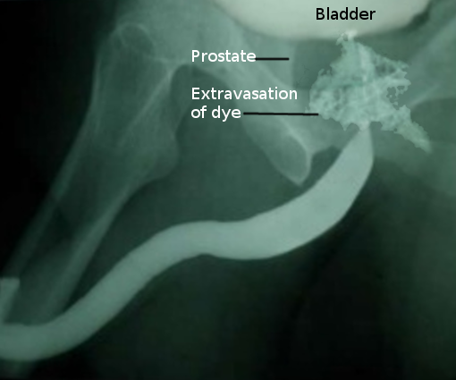 Retrograde urethrogram