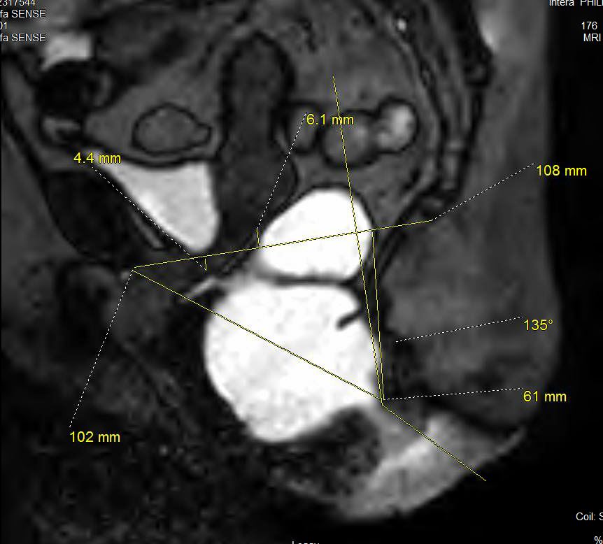 This sagittal image from MR Defecography shows severe perineal descent syndrome involving the posterior compartment