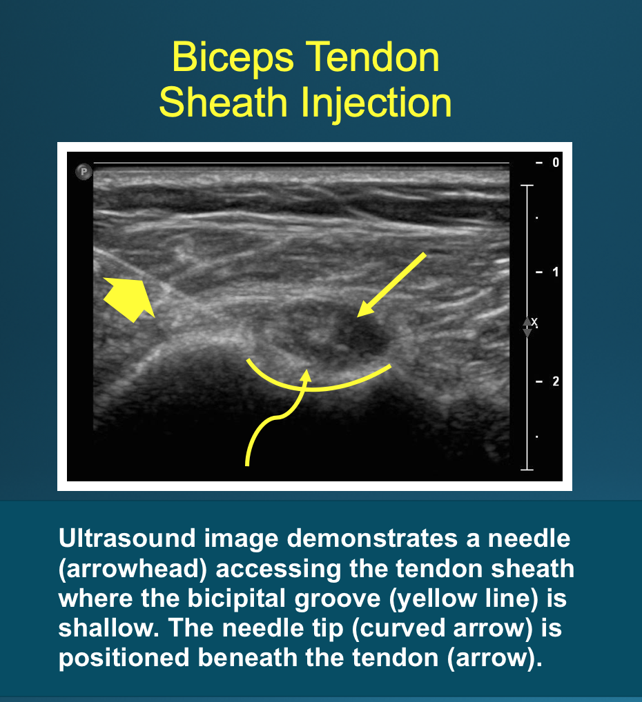 <p>Biceps Tendon Sheath Injection.</p>