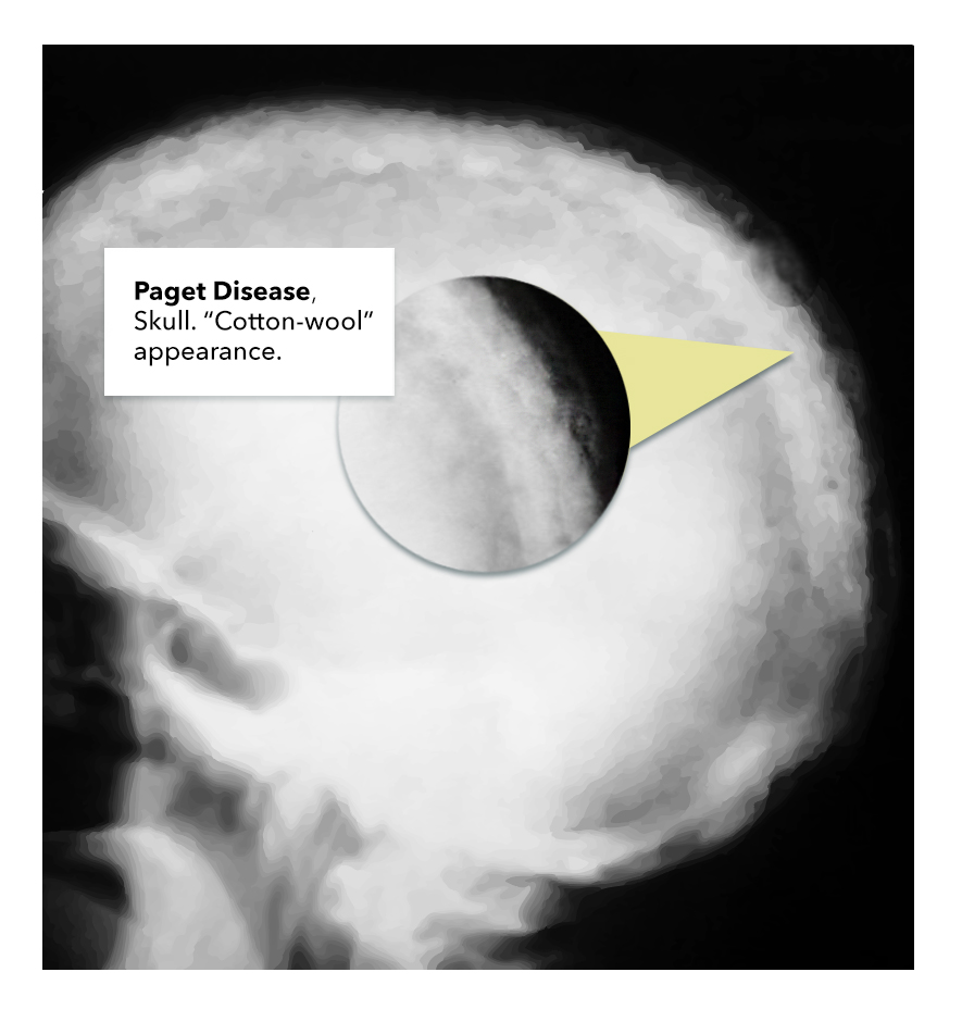 Paget Disease skull