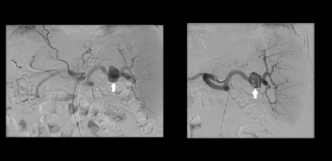 <p>Digital Subtraction Angiography