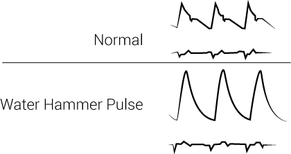 <p>Collapsing Pulse or Water Hammer Pulse</p>