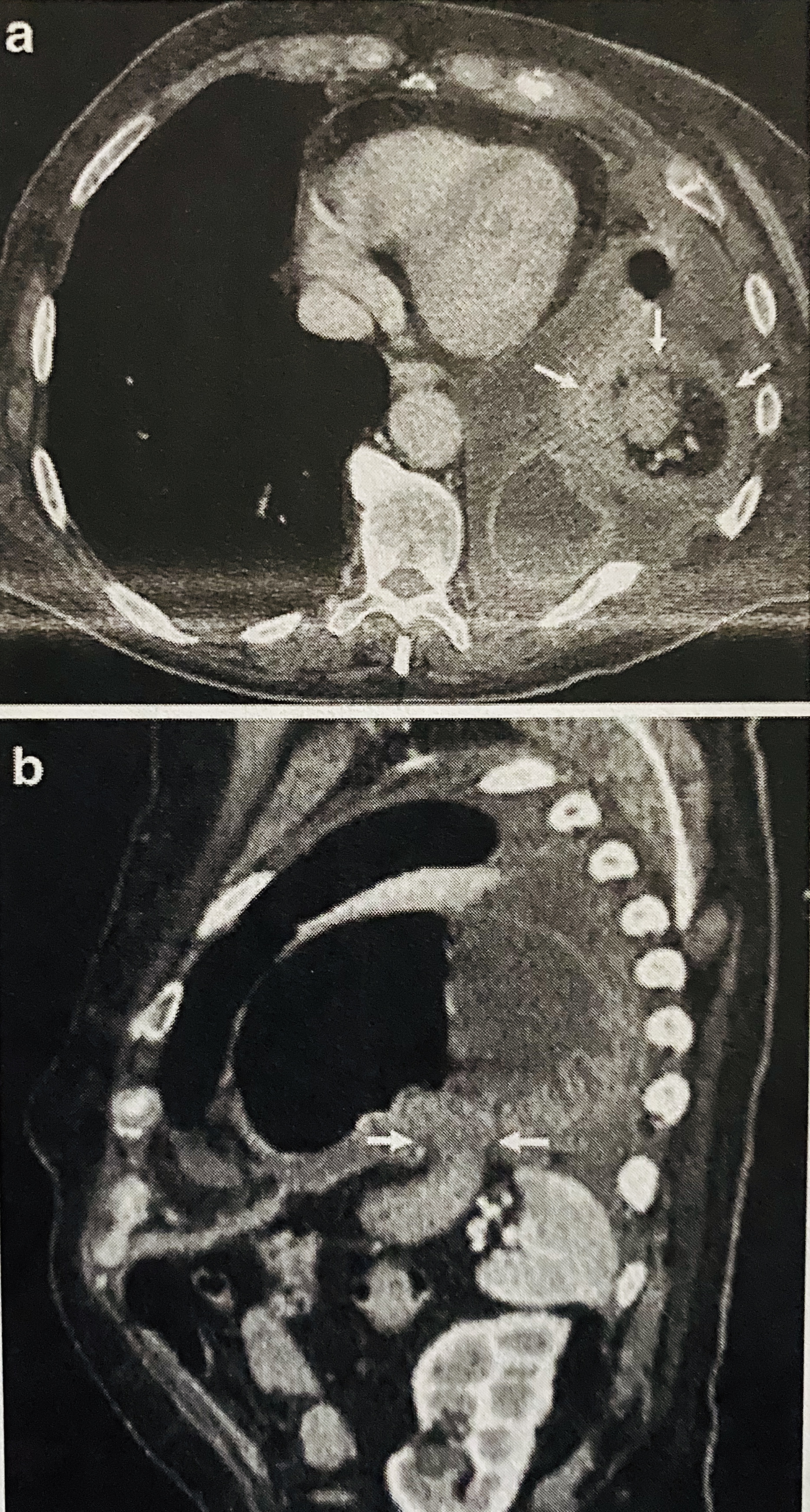 Collar sign showing herniation of the stomach through the left hemidiaphragm with narrowing and thickness at the level of the defect