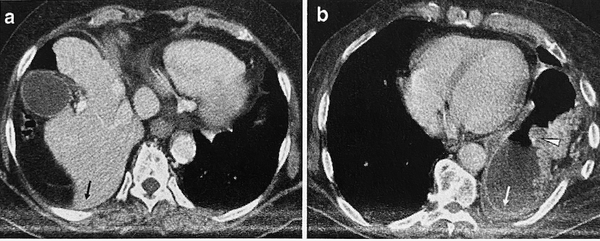 Dependent viscera sign - posterior costophrenic sulcus is obliterated