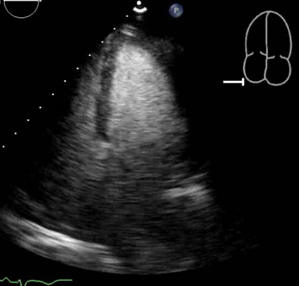 Mid-Ventricular Cardiomyopathy.

The picture shows the Left Ventricle in Diastole.