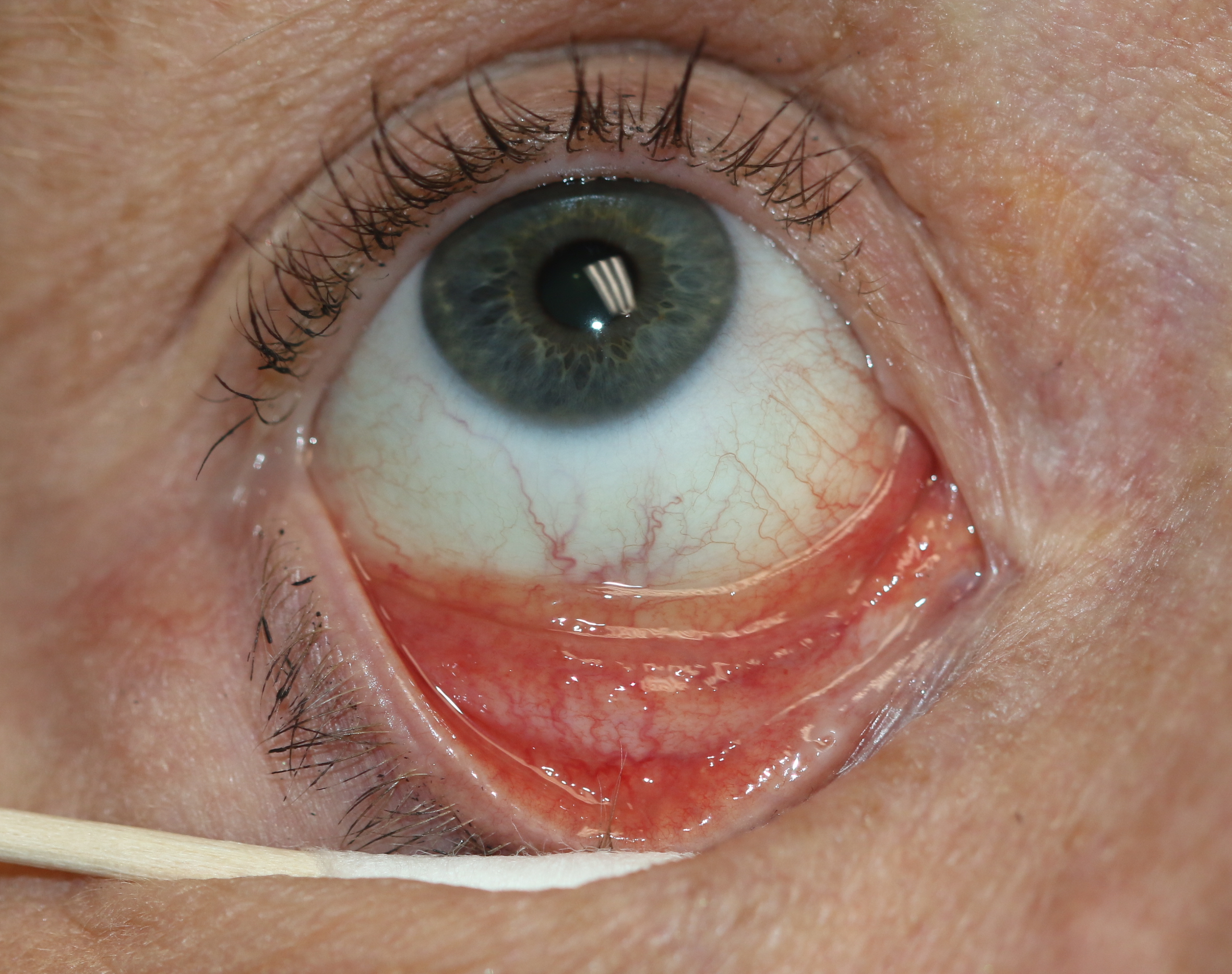 <p>Follicular Conjunctivitis