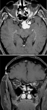 <p>Optic Nerve Sheath Meningioma