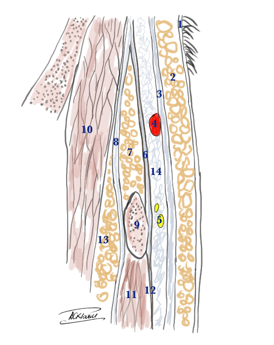 Superficial Temporal Artery and the Temporal branch of the Facial Nerve: anatomical cross section to show the relative layers above the zygomatic arch

1