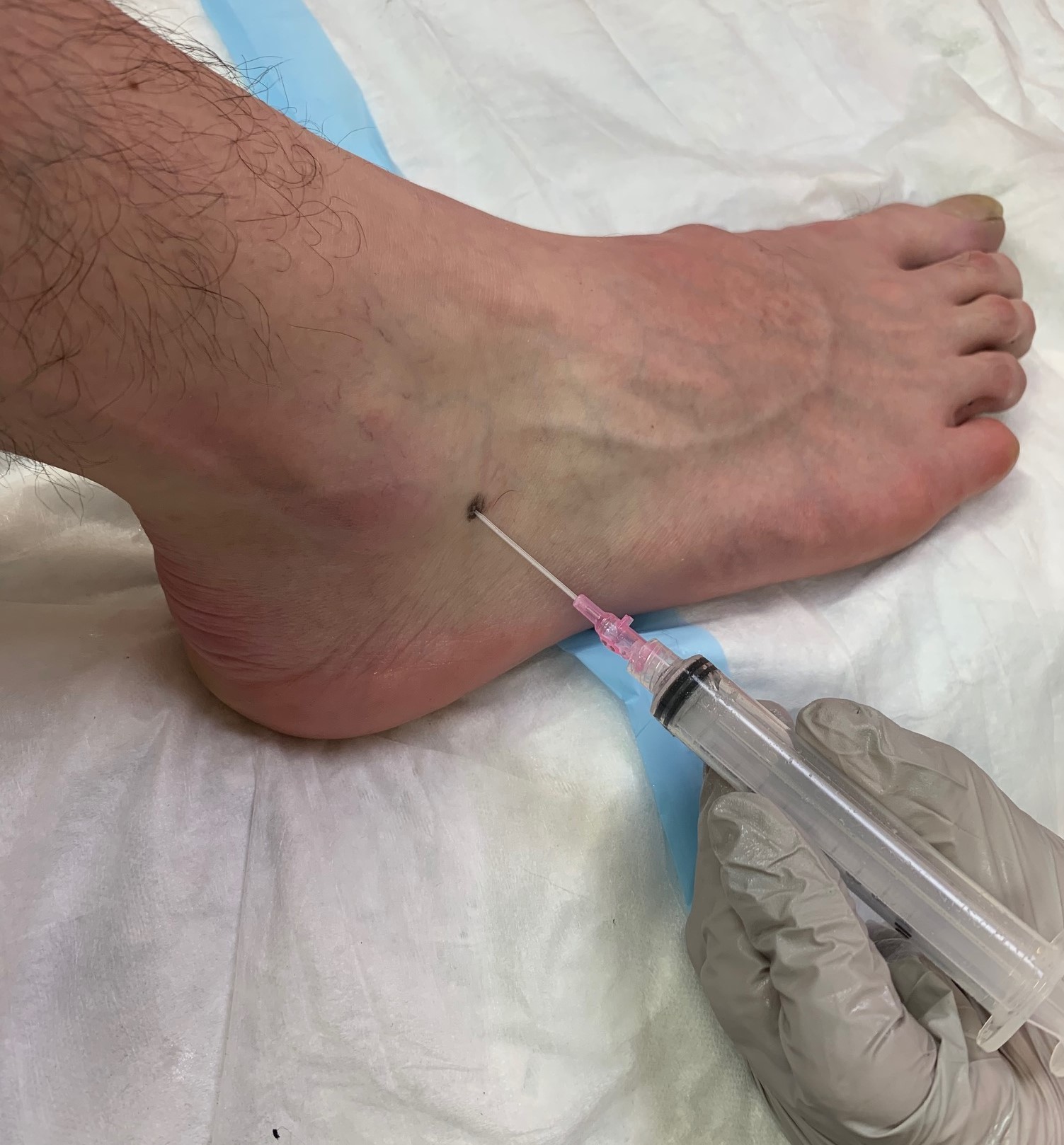 <p>Positioning and Location to Access Subtalar Ankle Joint