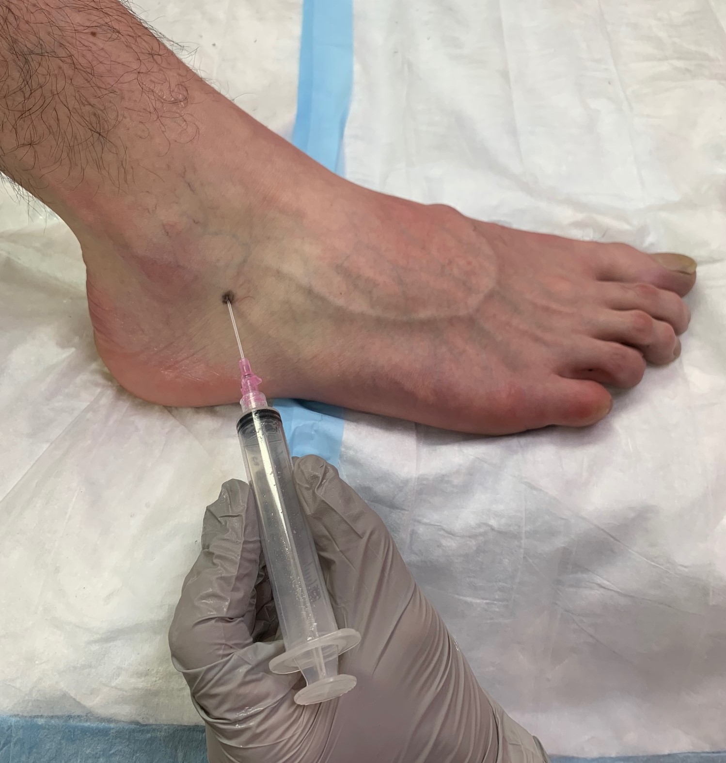 <p>Positioning and Location to Access Subtalar Ankle Joint (Lateral View)