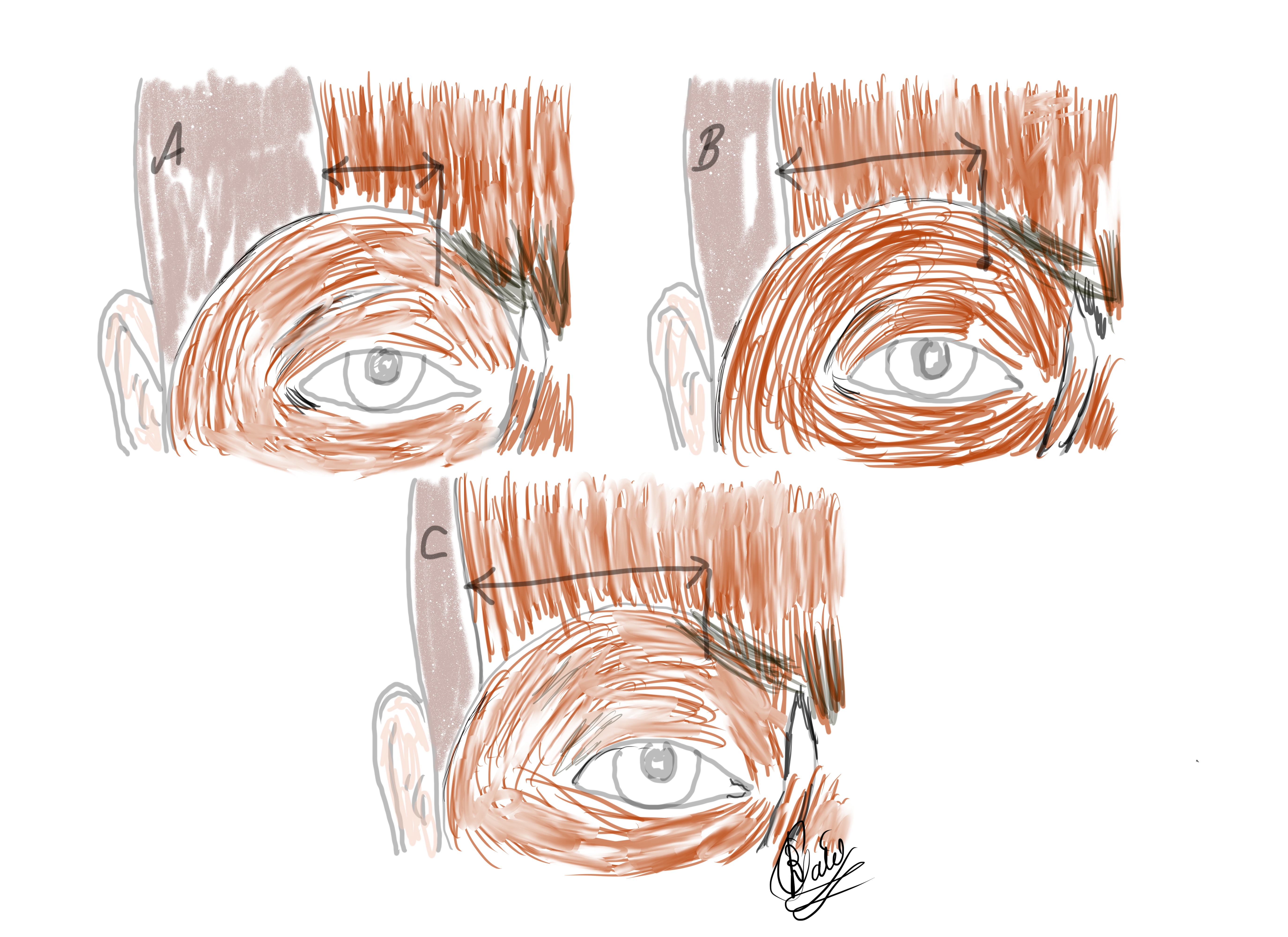 The Frontalis Muscle: The width of the frontalis muscle varies