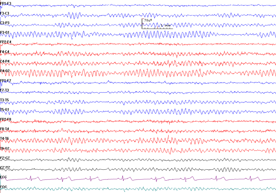 Normal EEG