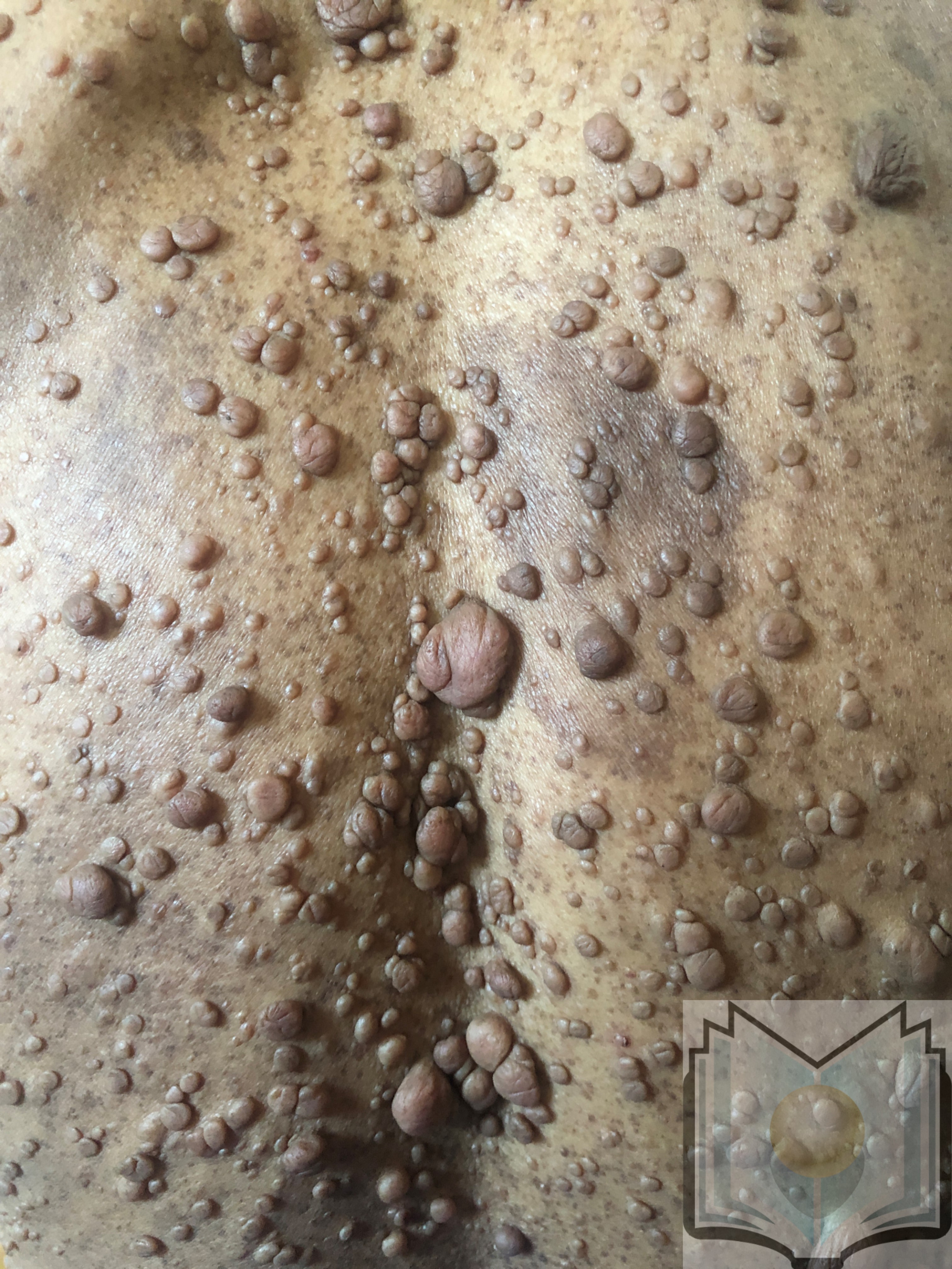 <p>Neurofibromatosis Type 2. Neurofibromatosis type 2 patients typically present with schwannomas and meningiomas.</p>