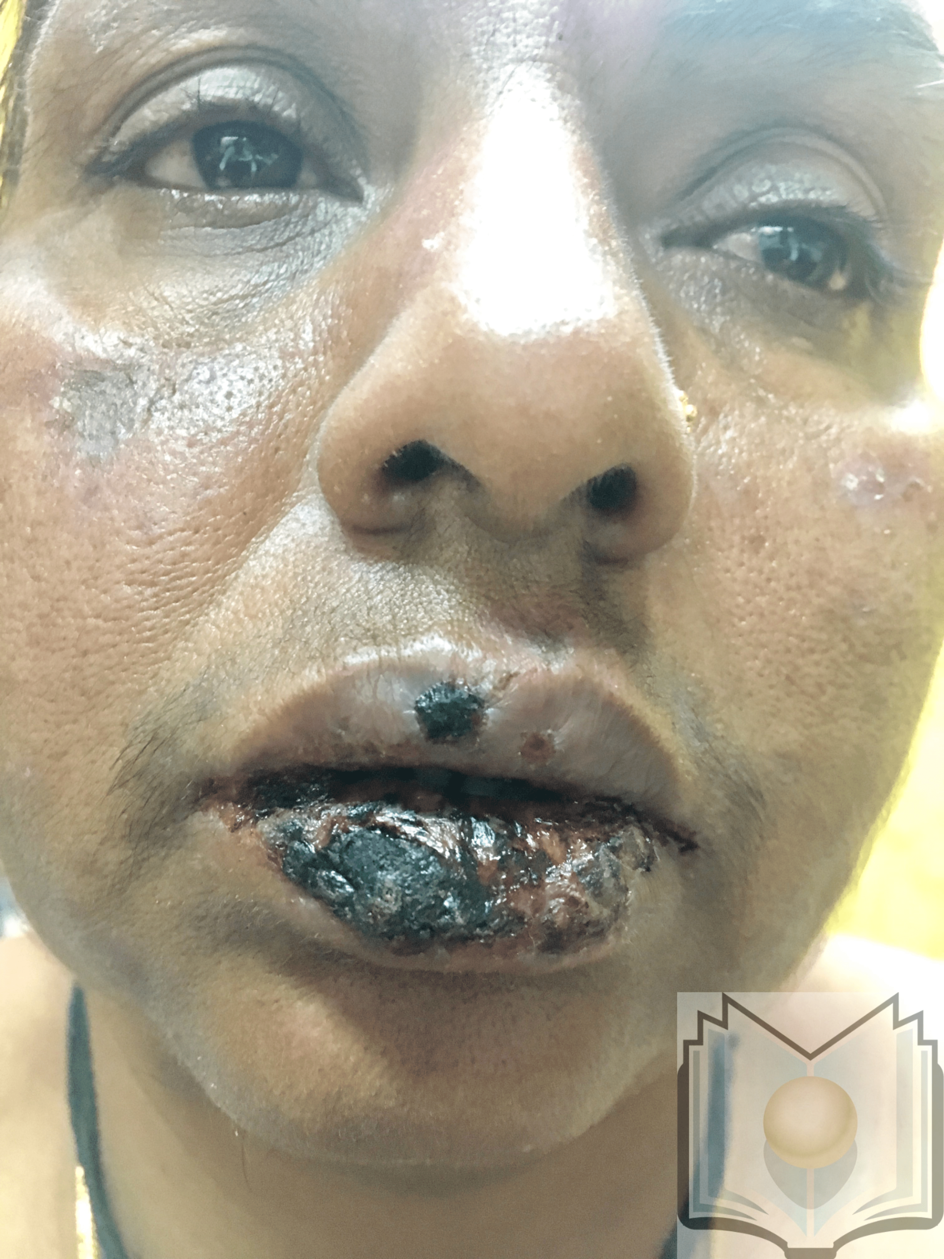 <p>Erythema Multiforme Oral Lesions