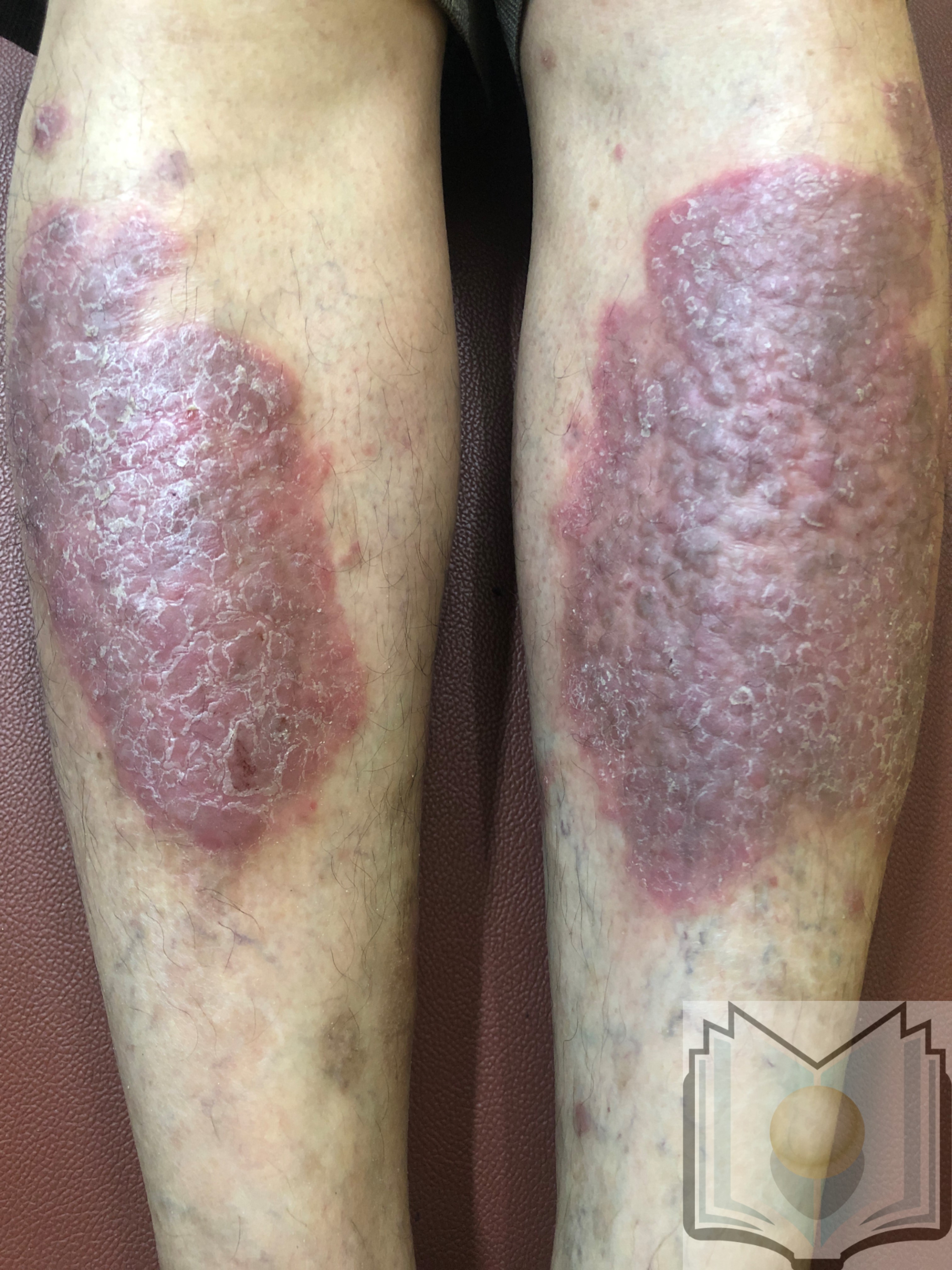 <p>Psoriasis, Bilaterally on the Lower Leg</p>