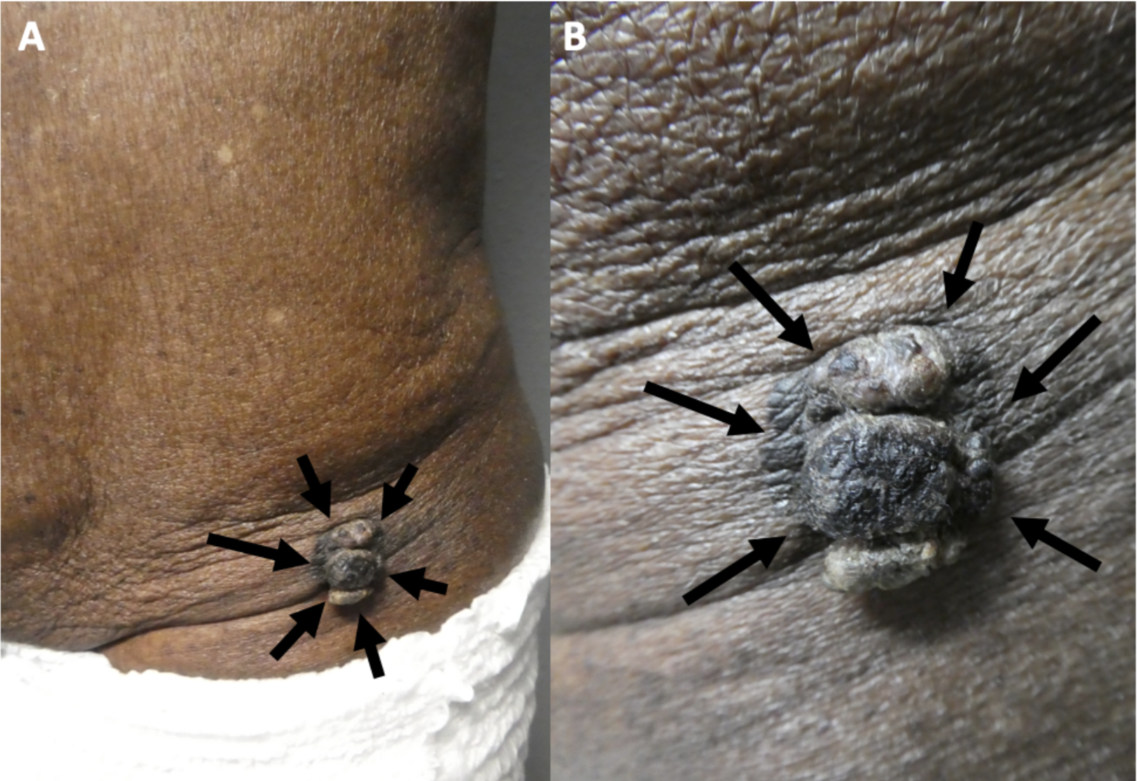 <p>Cutaneous Melanoacanthoma, Left Lower Abdomen