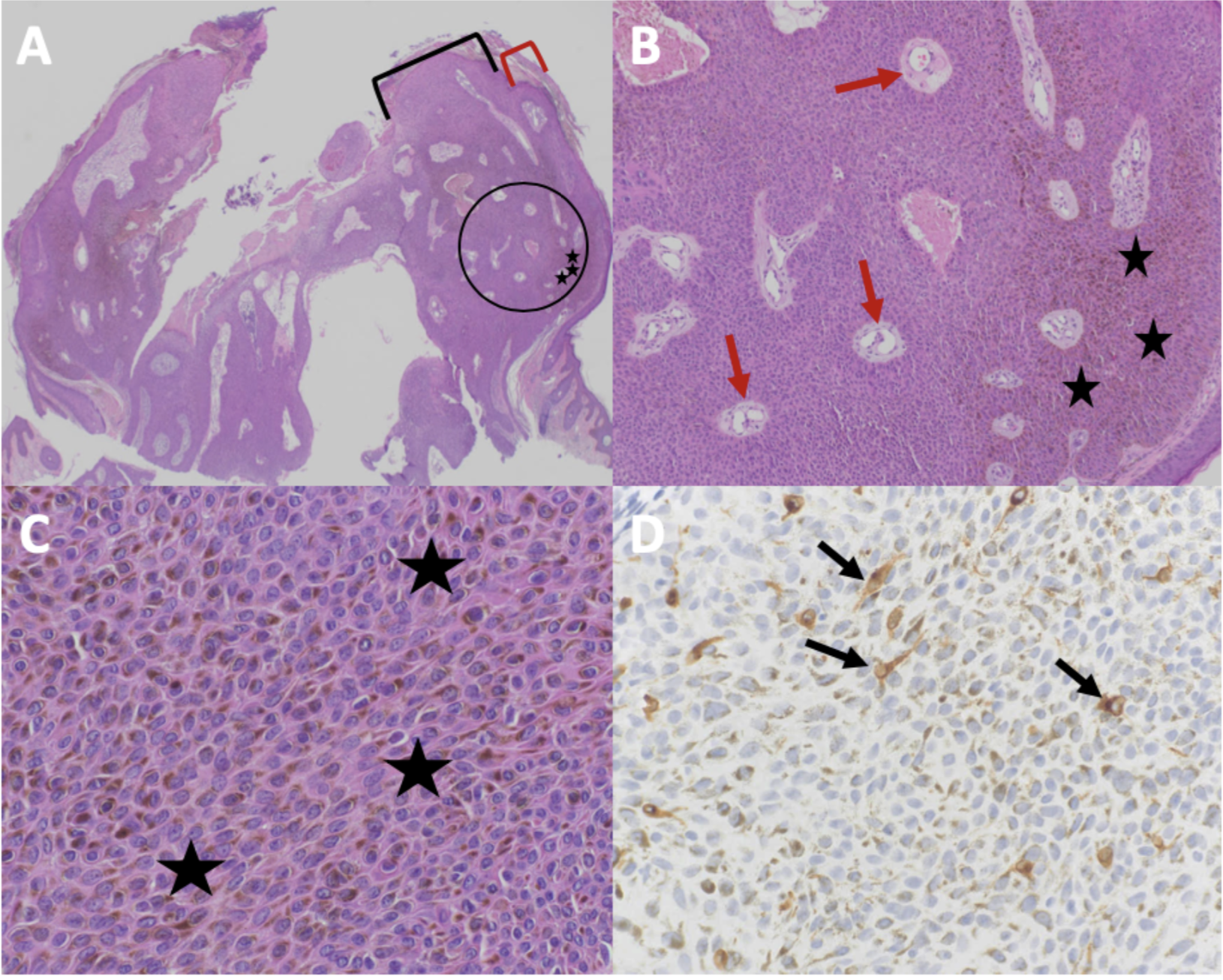 <p>Cutaneous Melanoacanthoma, Histopathology