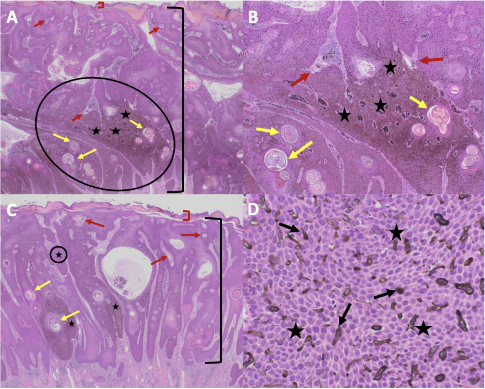 <p>Cutaneous Melanoacanthoma, Microscopic Features