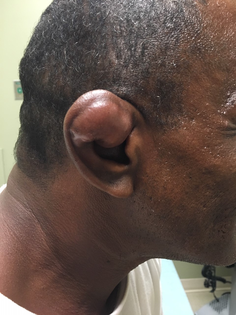 <p>Severe Cauliflower Ear&nbsp;Deformity