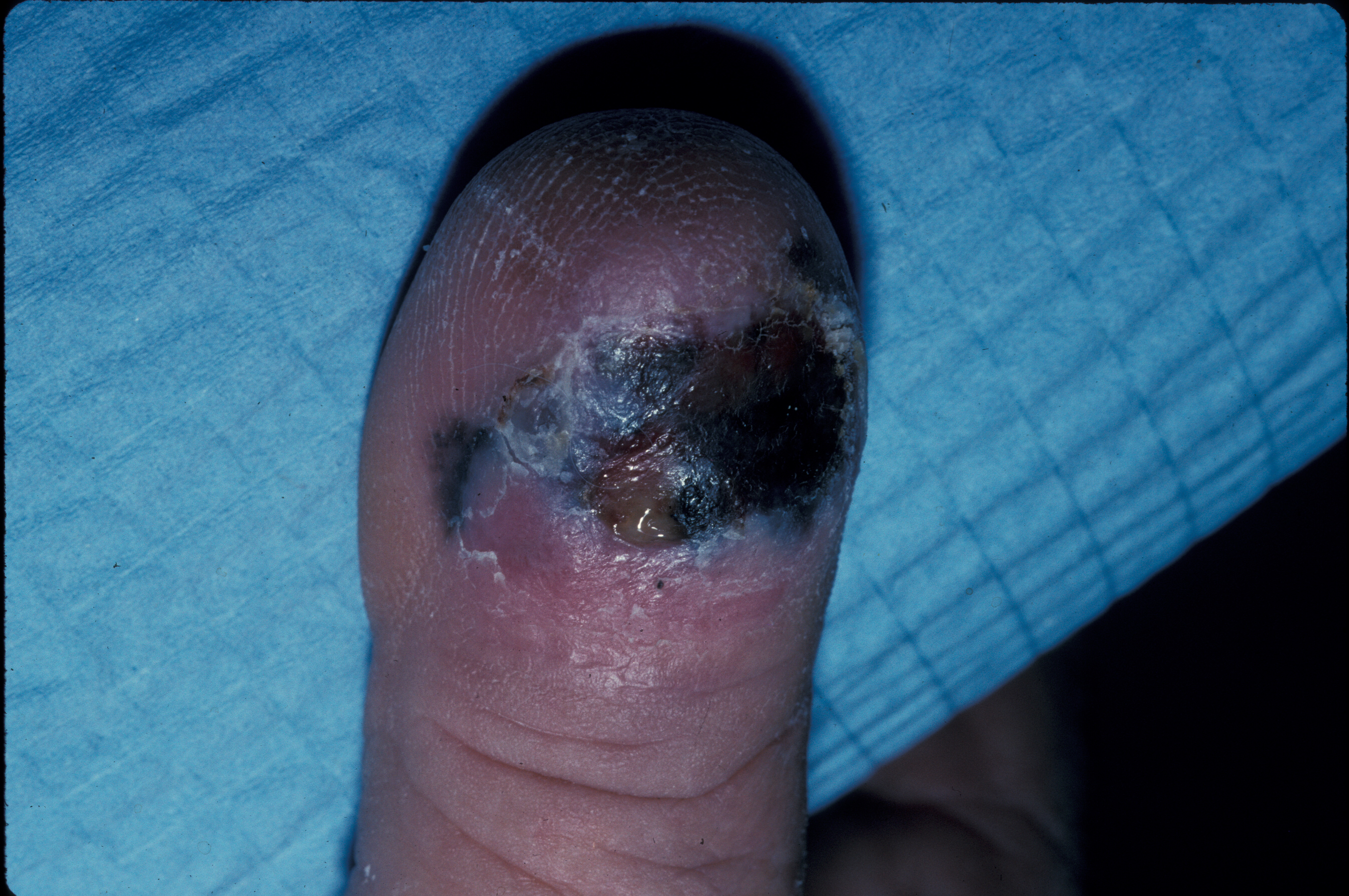 <p>Ulcerated Acral Lentiginous Melanoma