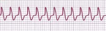 AVRT ECG strip