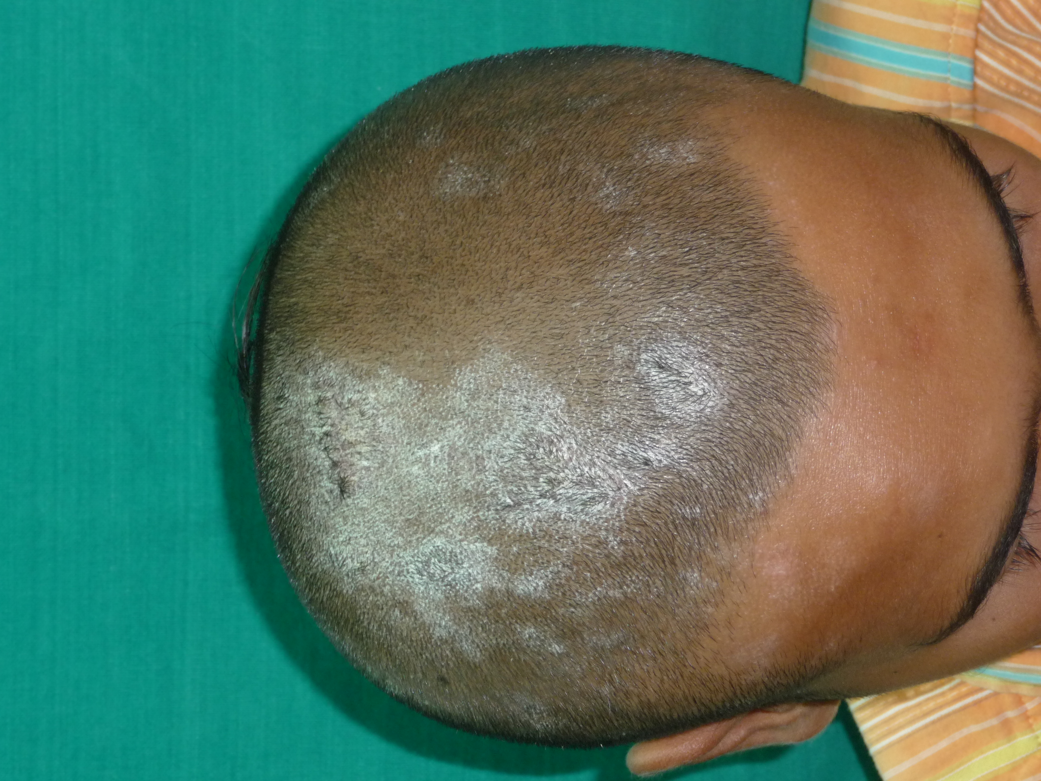 <p>Scalp Psoriasis</p>