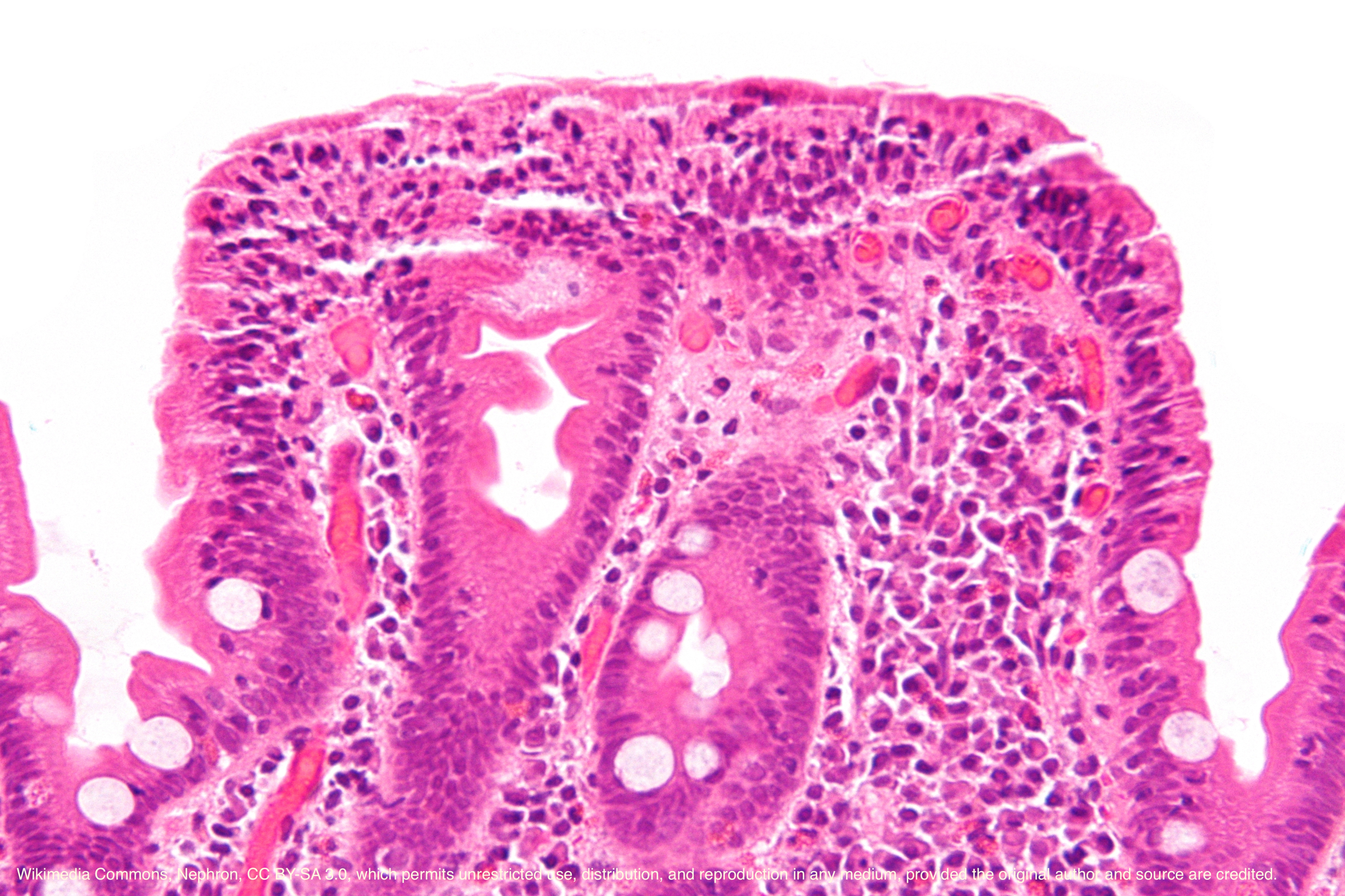 Very high magnification micrograph of celiac disease. H&amp;E stain