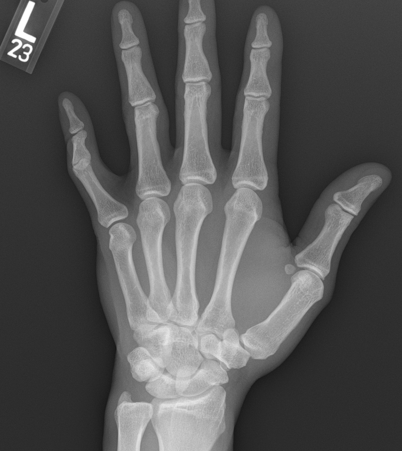 Boutonniere deformity of the 5th digit.