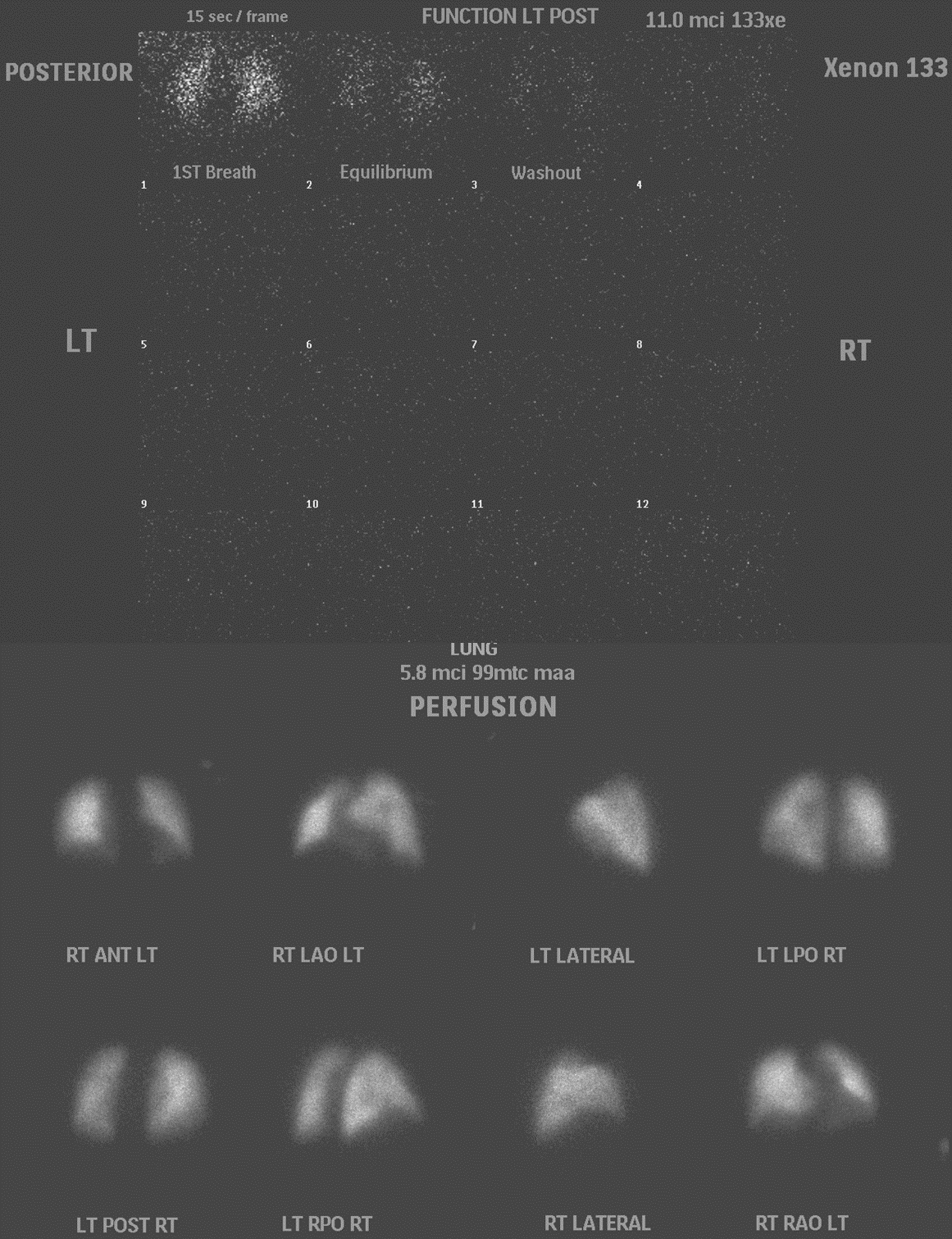 A normal ventilation and perfusion scan