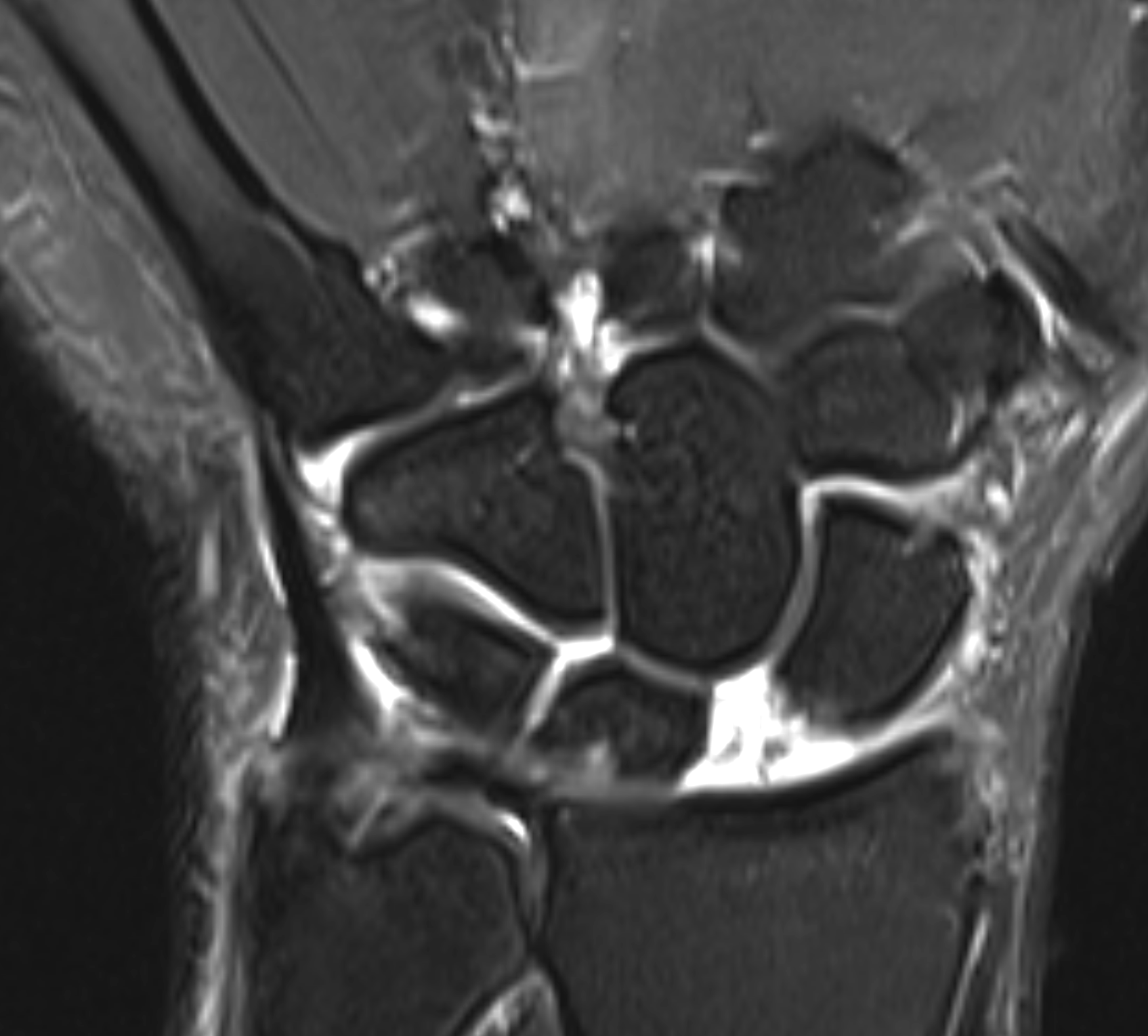 <p>Scapholunate Ligament Tear T2 Sequence. Coronal T2 fat-saturated sequence demonstrating a scapholunate ligament tear.</p>