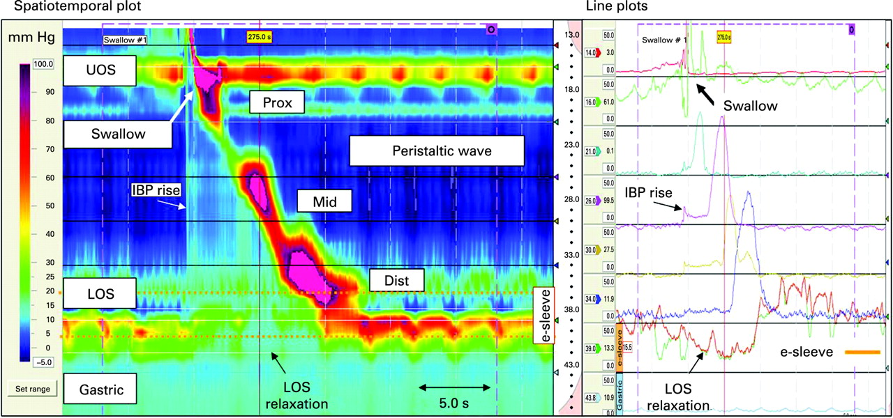 <p>Sample of High-Resolution Manometry</p>