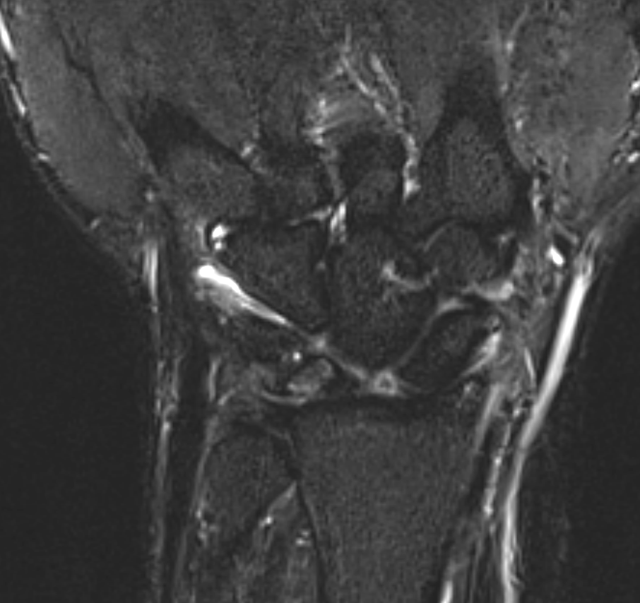 <p>Scapholunate Advanced Collapse T2 Sequence