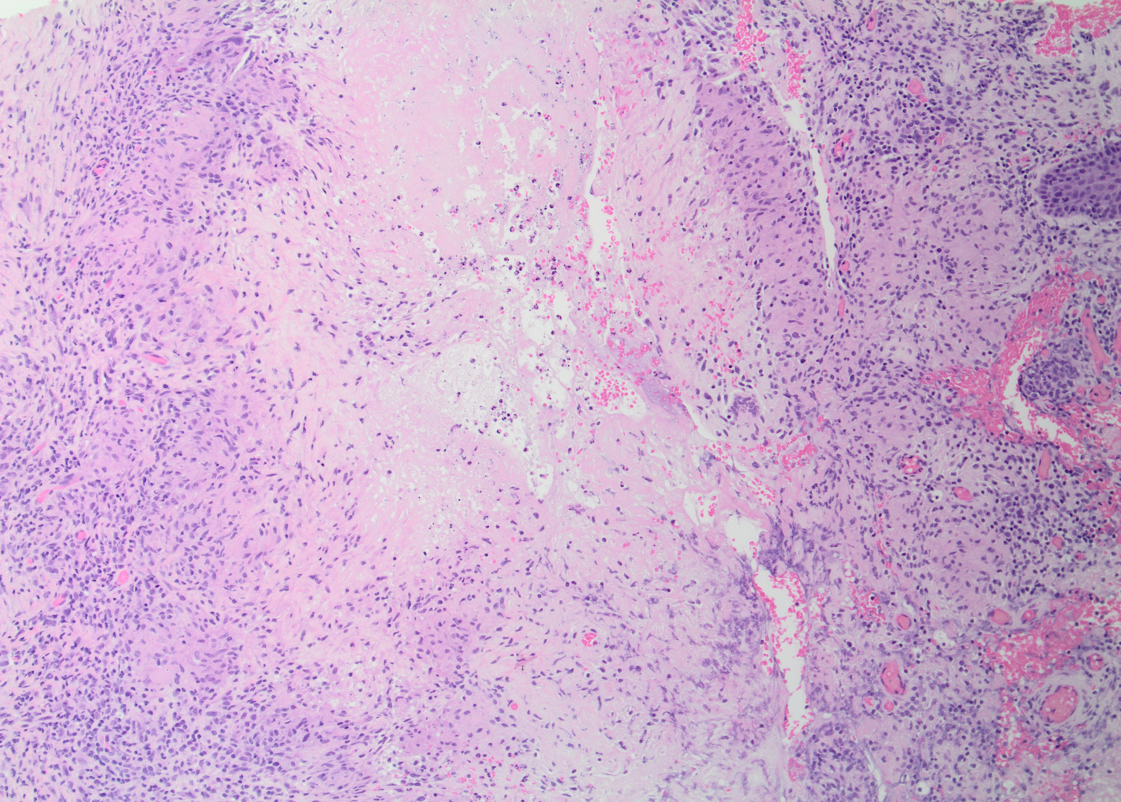 <p>Caseating Granuloma. Caseating granuloma is present in some cases of lupus miliaris disseminatus faciei.</p>