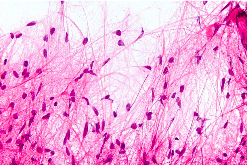 <p>Microscopic Features of Pilocytic Astrocytoma. Hair-like cell processes can be observed with H&amp;E staining.</p>