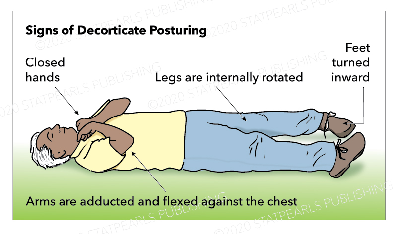 <p>Decorticate Posturing