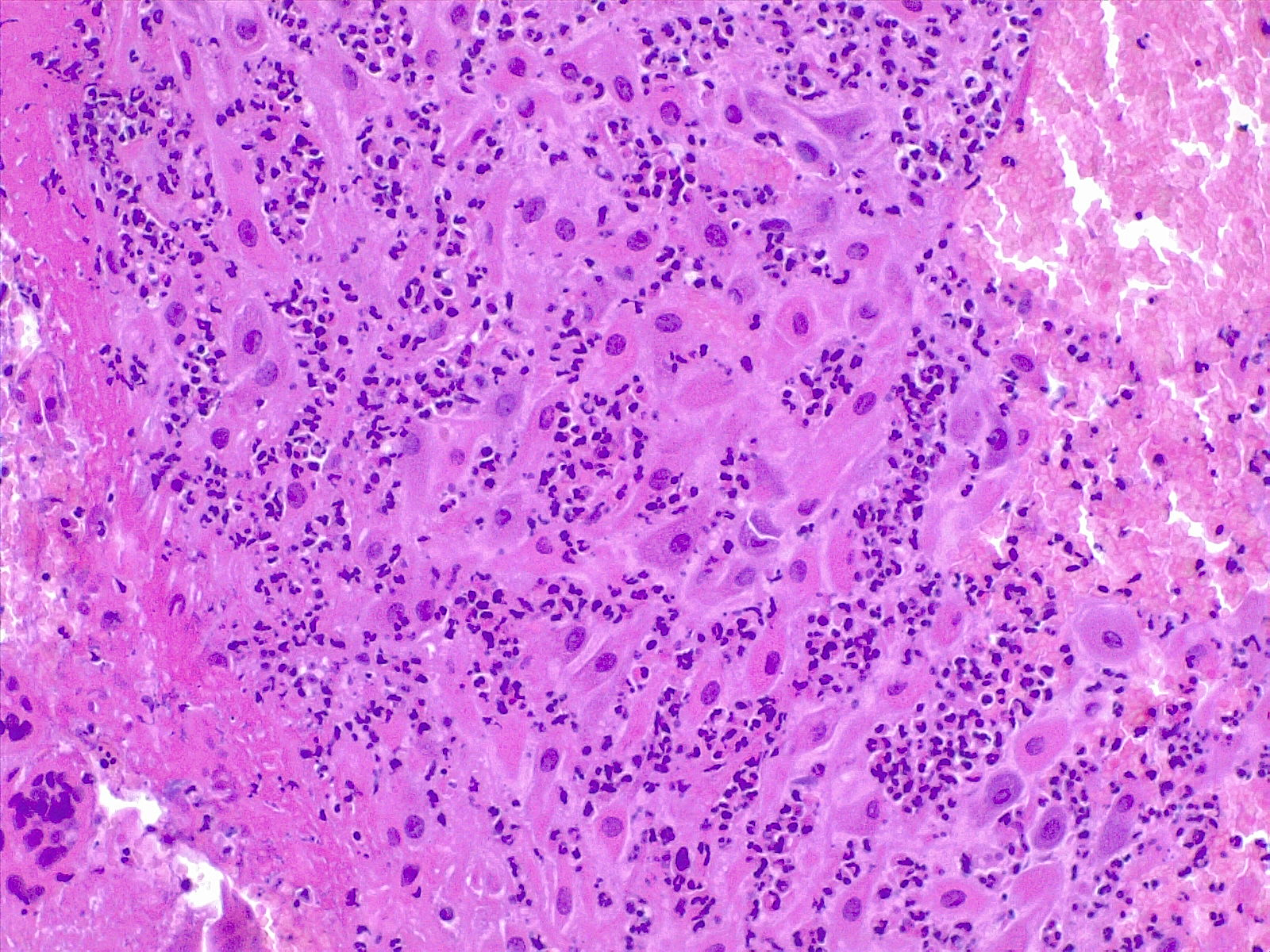 <p>Deciduitis