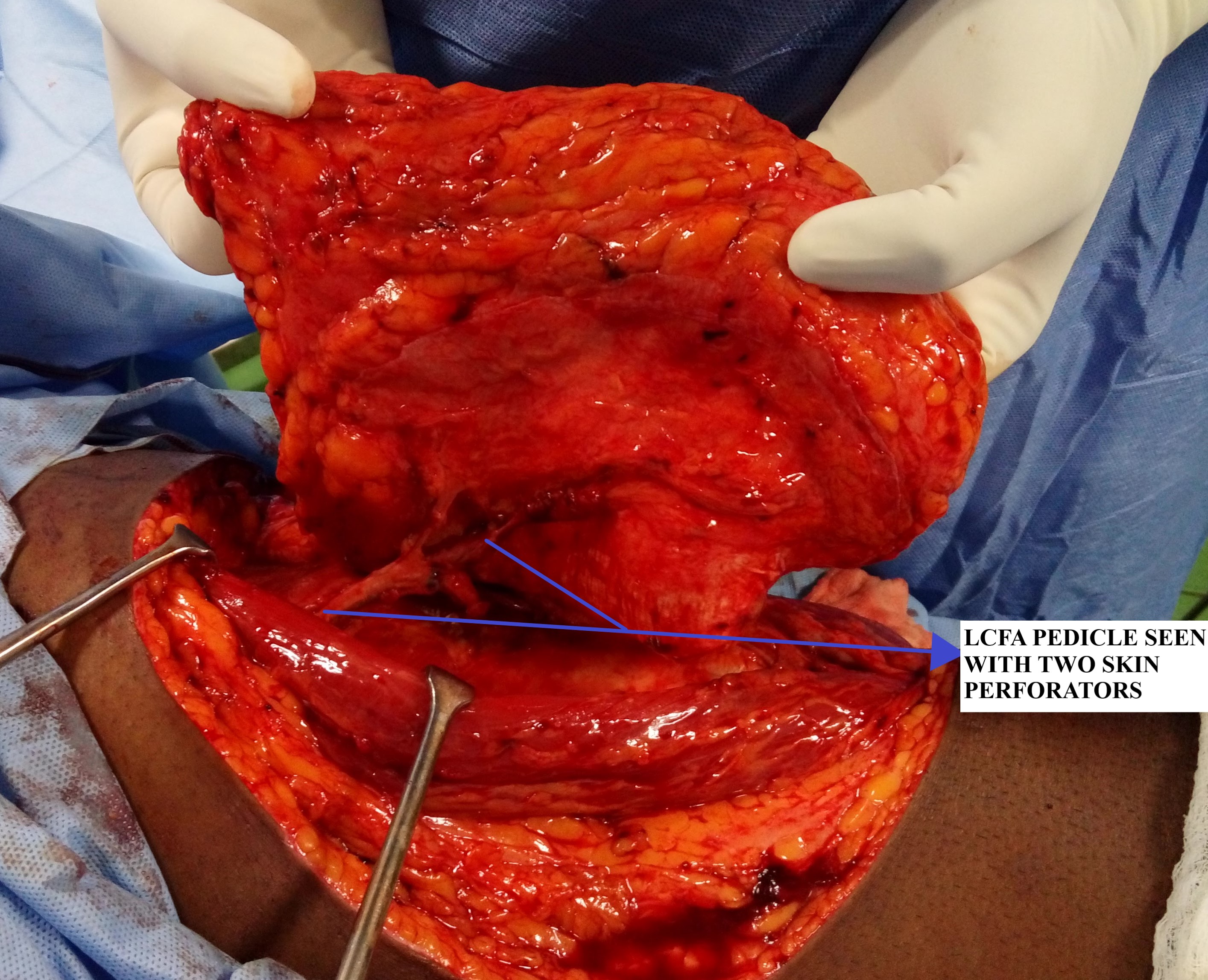 ALT PEDICLE DISSECTION AND ISOLATION