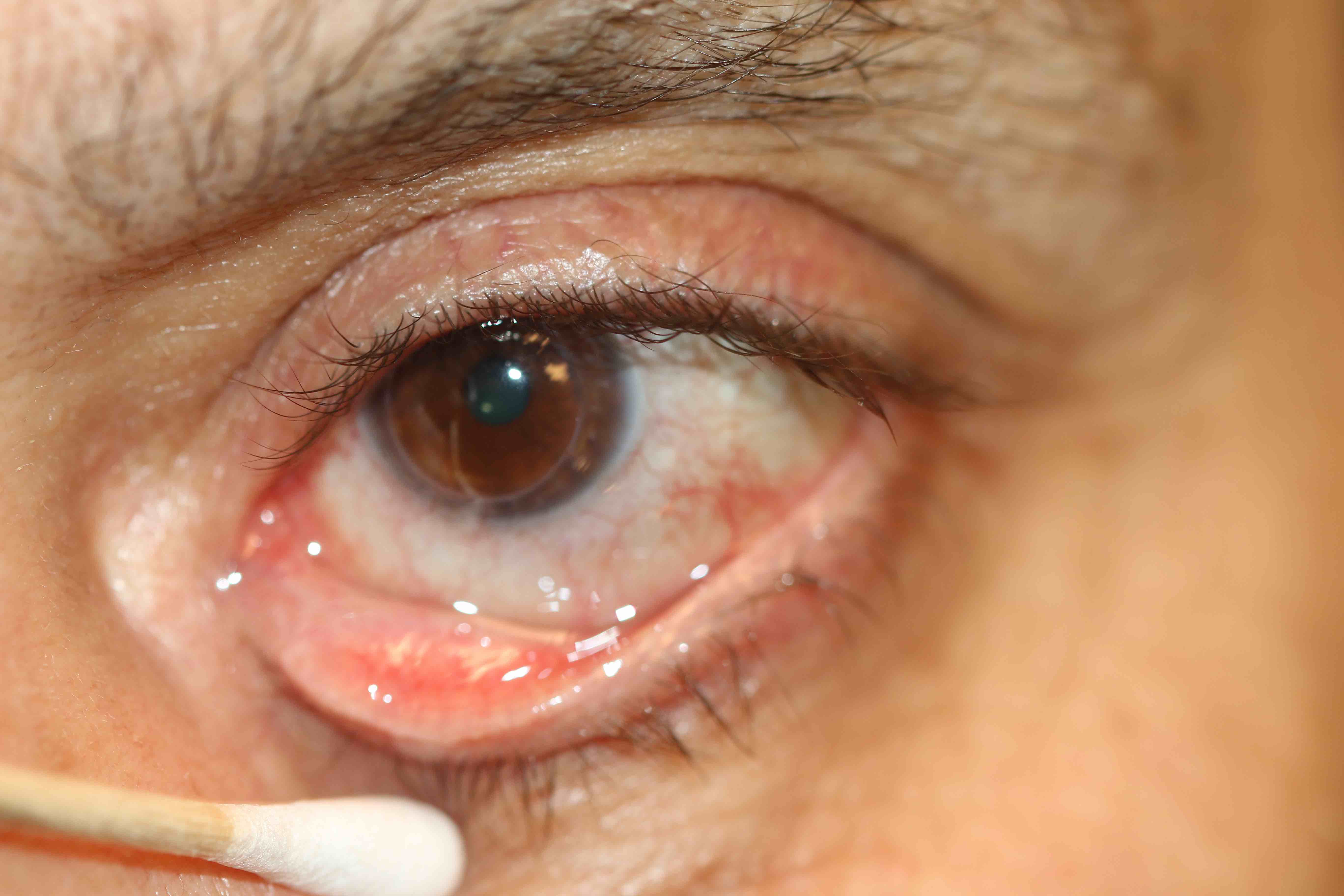 Punctal membrane caused by a chronic follicular conjunctivitis