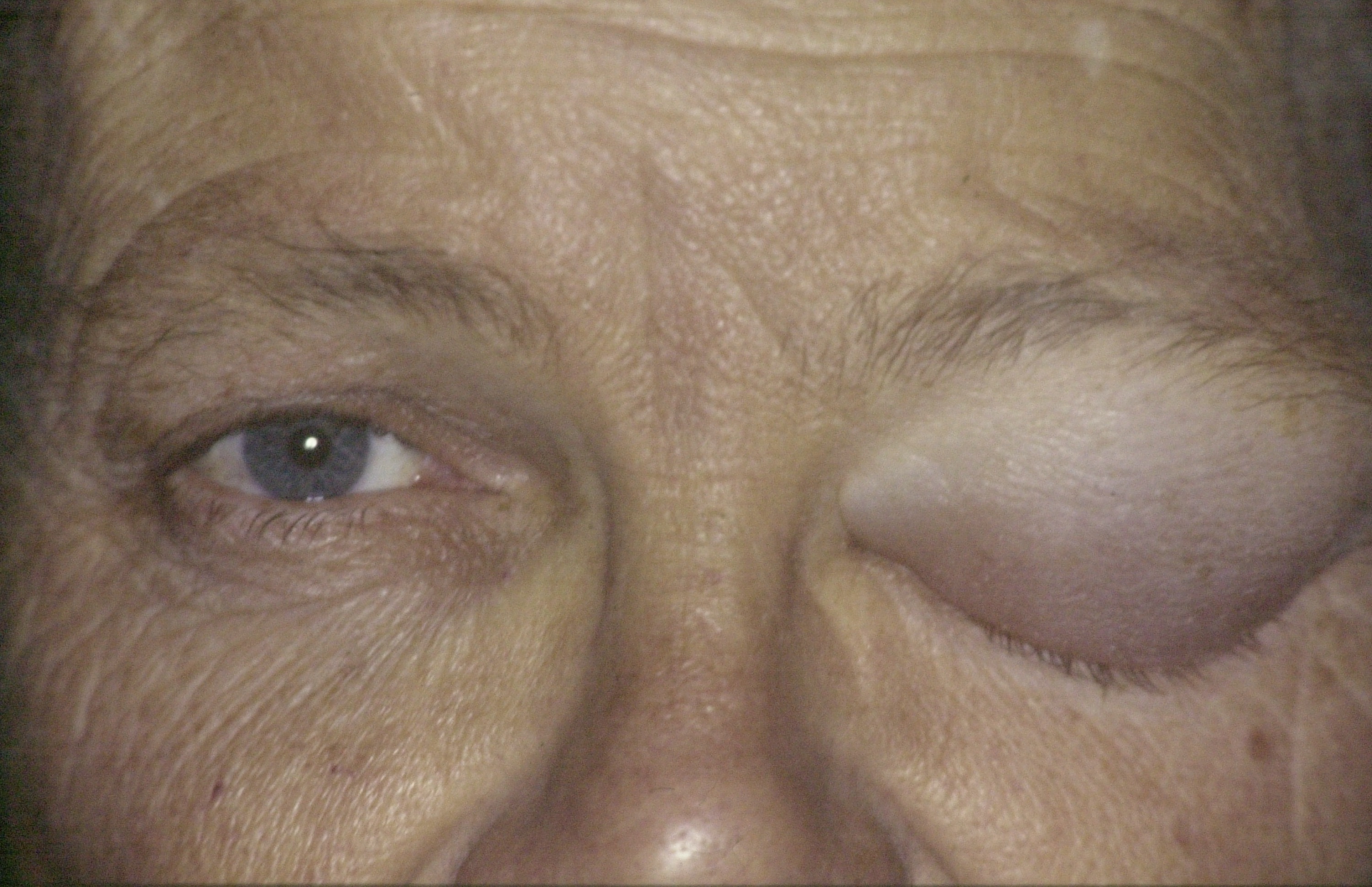<p>Blepharochalasis,&nbsp;Acute Eyelid Edema Episode