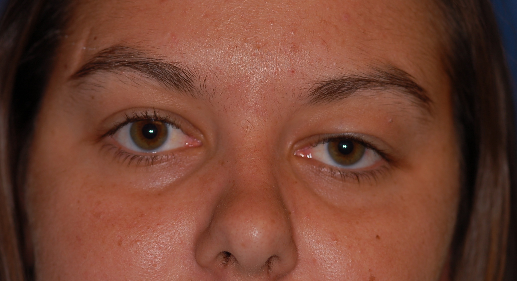 <p>Blepharochalasis, Recurrent Unilateral Eyelid Swelling