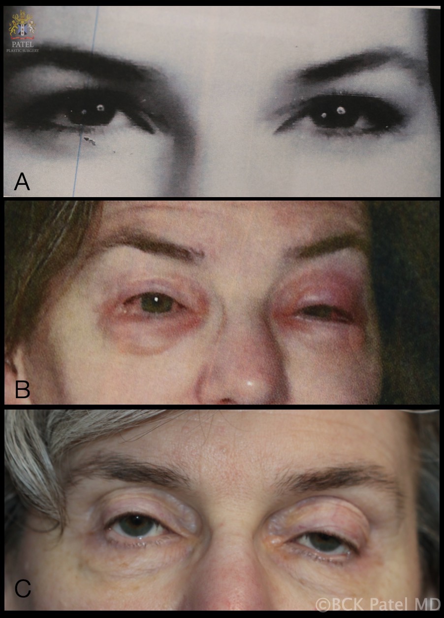 <p>Evolution of Blepharochalasis Syndrome