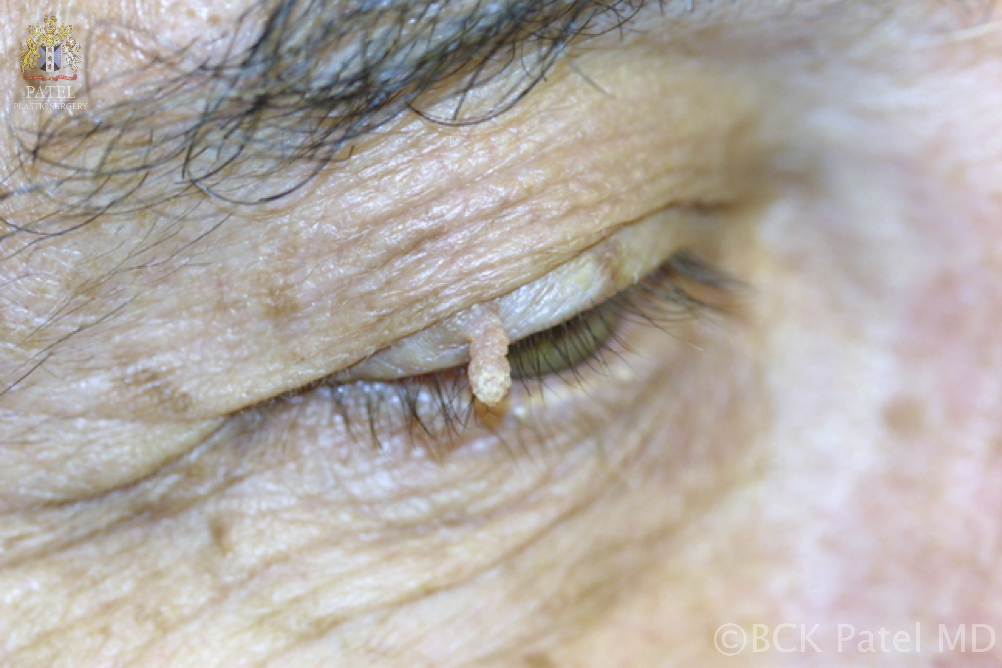 <p>Cutaneous Horn or Cornu Cutaneum