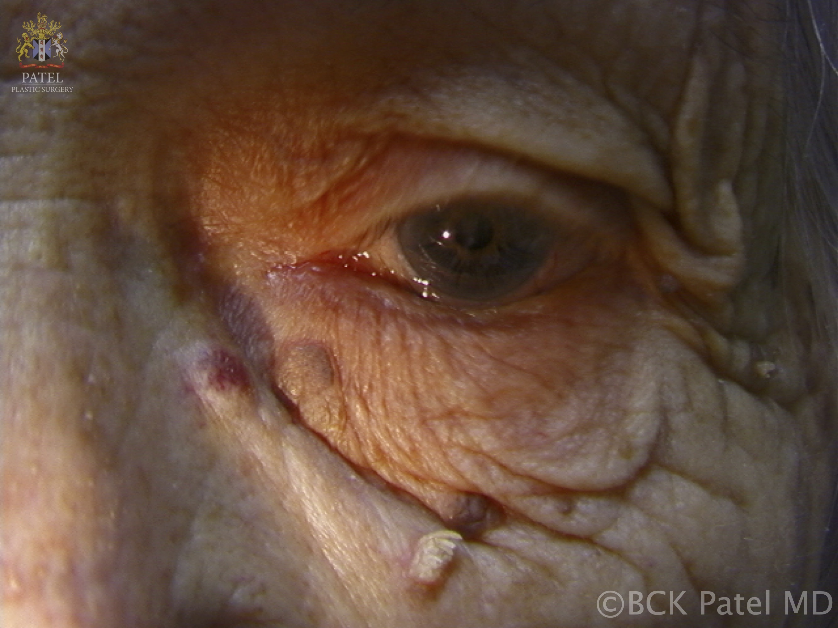 <p>Acrochordons or Skin Tags