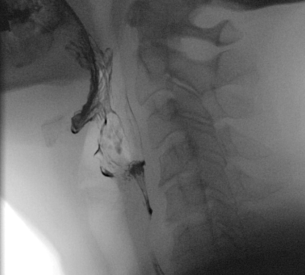 Single lateral image demonstrates phonation evaluation at the level of the hypopharynx.