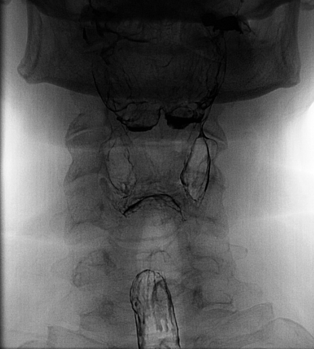 Single frontal magnified field of view of the hypopharnx during phonation evaluation.