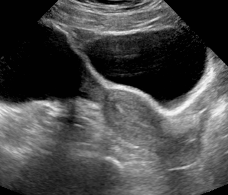 <p>Transabdominal Long Image of Normal Uterus, Ultrasound. This image shows a view of a normal uterus on ultrasound.</p>