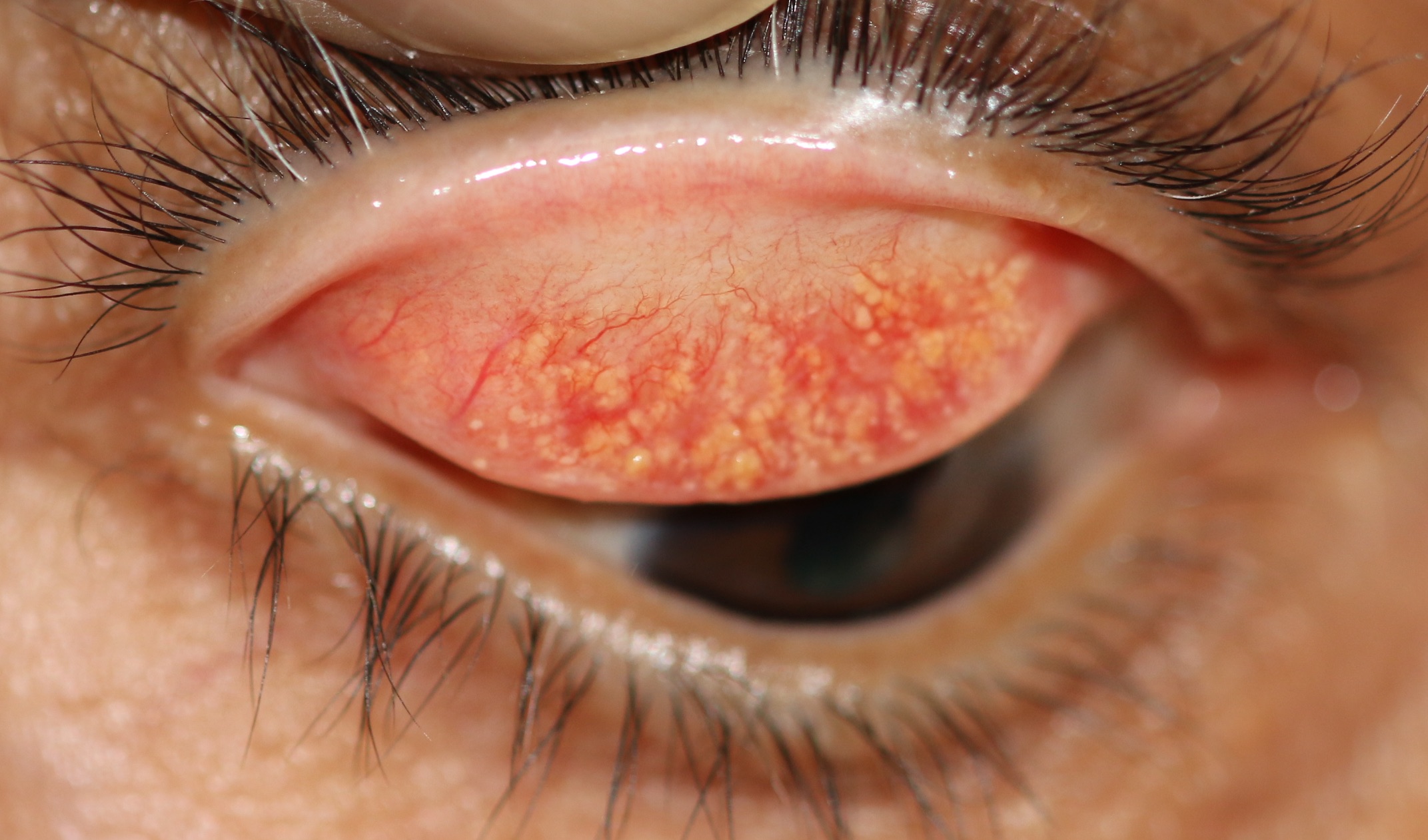 Tarsal conjunctival concretions: extensive concretions of the tarsal conjunctival surface