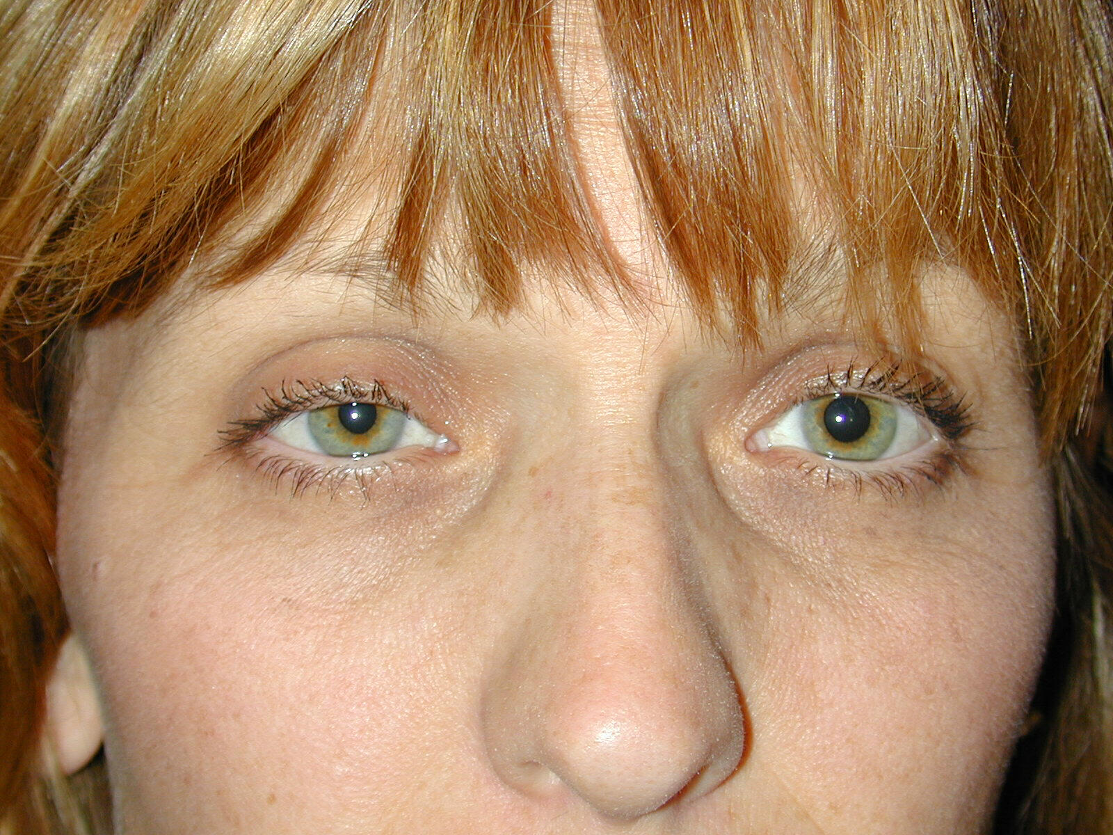 Right sided ptosis and miosis i.e. horners syndrome