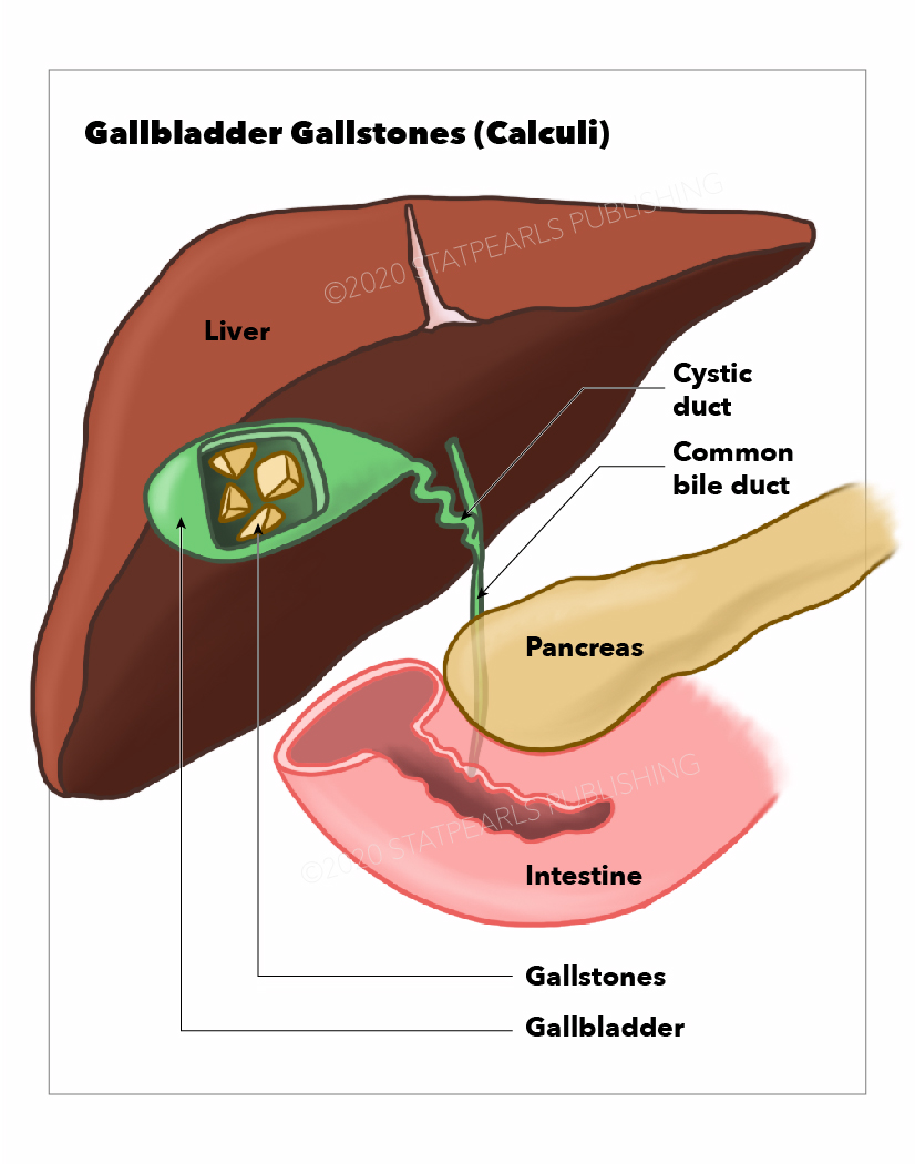 <p>Gallbladder Gallstones (Calculi), Common Bile Duct